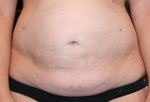 Am I on the right healing path 2 months after Smart Lipo?