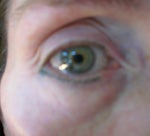 Tarsal strips, SOOF lift and fillers, scar reduction and canthoplasty