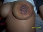 Discharge, rash months after periaerola breast augmentation 