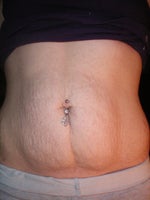Does tummy tuck help remove stretch marks?