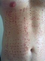 Burns on chest after laser hair removal