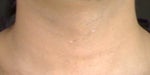 How can I remove my scars on neck?