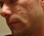 Treatment of Acne Scarring outside of Fraxel...