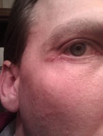 Eye irritation in outer corner/4 weeks post lower Bleph