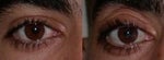 Non-symmetrical eyelids
