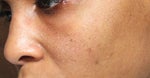 I need recommendations for Ohio MDs proficient in Microliposuction of the face