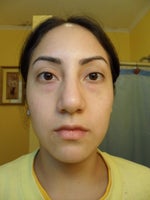 Has anyone ever have Dr. philip miller for Rhinoplasty?