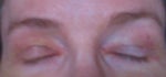 I think my doctor bungled my eyelid surgery. Doctors and patients please look at photo and comment. Photo is taken 9 days post .