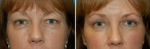 9 Things I Wish I Knew Before Eyelid Surgery (Blepharoplasty)