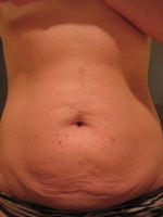 My plastic surgeon said he will do a mini tummy tuck on me.  Will I have a good result without a full tummy tuck?  