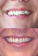 18 Things I Wish I Knew Before Invisalign