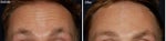 14 Things I Wish I Knew Before Botox