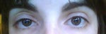 Anyone else experienced a triple eyelid after ptosis surgery?