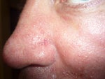 What can I do to reduce my acne flare up day 2 post treatment?