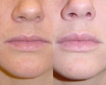 10 Things I Wish I Knew Before Restylane