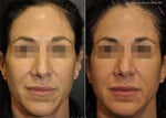 12 Things I Wish I Knew Before Sculptra