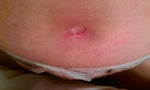 Help... Why do I have a bruise all of a sudden all around my belly button