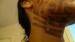Recovery time for IPL burns/PIH in asian skin ?!