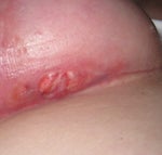 Open Wound under breast