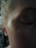 Botox divots in eye area! HELP!!!!!!!!!!!!