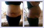 Loosing more weight AFTER abdominal liposuction