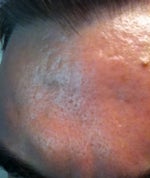 I need advice on my forehead!!!