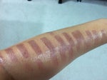Burn Marks to forearm post laser hair removal using IPL..