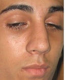 Could You Point out What Parts of my Nose Look Swollen 18 Days Post Op?