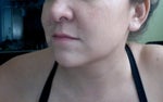 radiesse - Had it done on Friday and my face looks worst