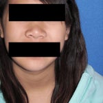 Rhinoplasty surgeon reccomendations?