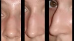 Rhinoplasty at 14?