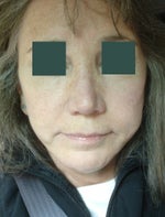 Where can I post my specific rhinoplasty question...?
