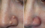 Are There Any Surgeons in LA That Use Radio Frequency Surgery for Mole Removal?