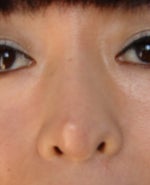 Need to Fix Asian Nose Asap. Which Skillful Doctor Can Help Me?
