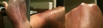 20% AHA lotion ruined hands