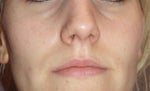 I'm Very Intersted in Getting Fat Injections or Fat Transfers for Volume Loss in my Face- Who Are The Best Drs?
