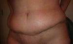 Swelling above incision 40days Post Op