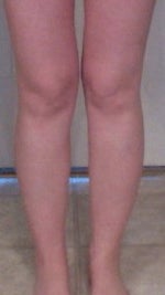 Calf and Ankle Liposuction in the Atlanta Area Doctor Recommendations (photo)