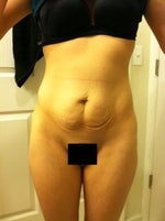 BBL without a Tummy tuck, will it still look okay?