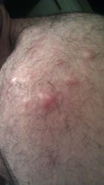 White Unpoppable Bumps on Shoulder Blades for Years, Minocycline Didn't Help, Other Options?