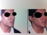HELP: Considering Rhinoplasty (PICS INCLUDED)