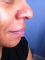 Need Doctor in Miami, Tampa or Orlando W/success & EXP Doing African American Rhinoplasty?