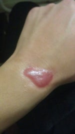 How do I reduce the appearance of my purple scar?