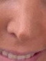 Tip of my nose is red and dry a year after rhinoplasty