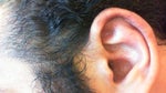 Help for Otoplasty Results