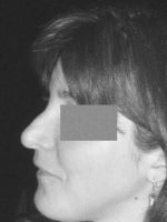 Price of rhinoplasty for Dr Naficy?