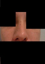 Thick, Oily Skin, Bulbous and Long- Anyone Have a Similar Nose?