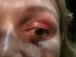 After Upper Blepharoplasty - Does wearing makeup or false eyelashes, cause inflammation after 3 weeks?