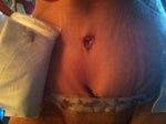 Does anyone have pinched or bunched skin on incision line is this temporary??