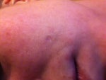 can red indented marks/scars heal themselves?